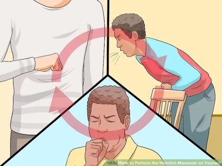 Heimlich-Maneuver
